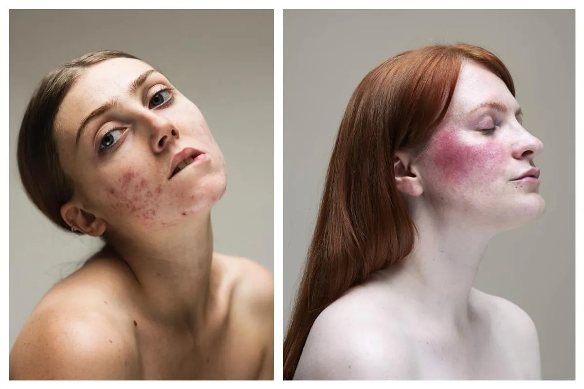 Iza šminke: Žene odbacuju stigmu 'nesavršene' kože u odličnom fotoprojektu