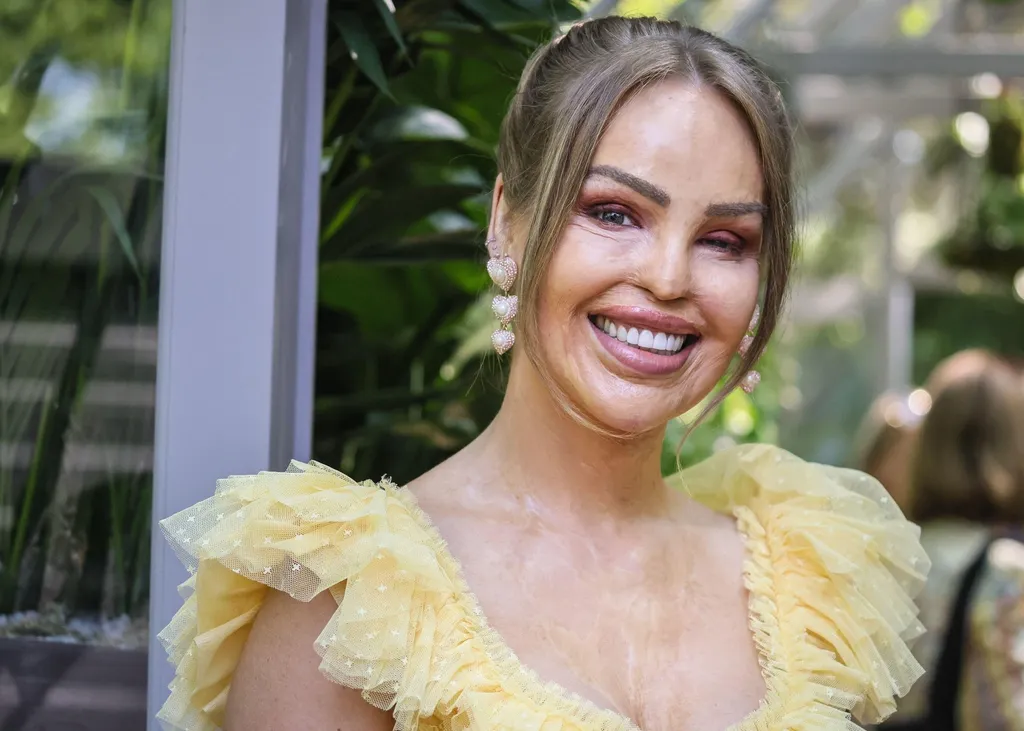 Dečko joj spalio lice kiselinom, imala 400 operacija: Evo kako danas izgleda