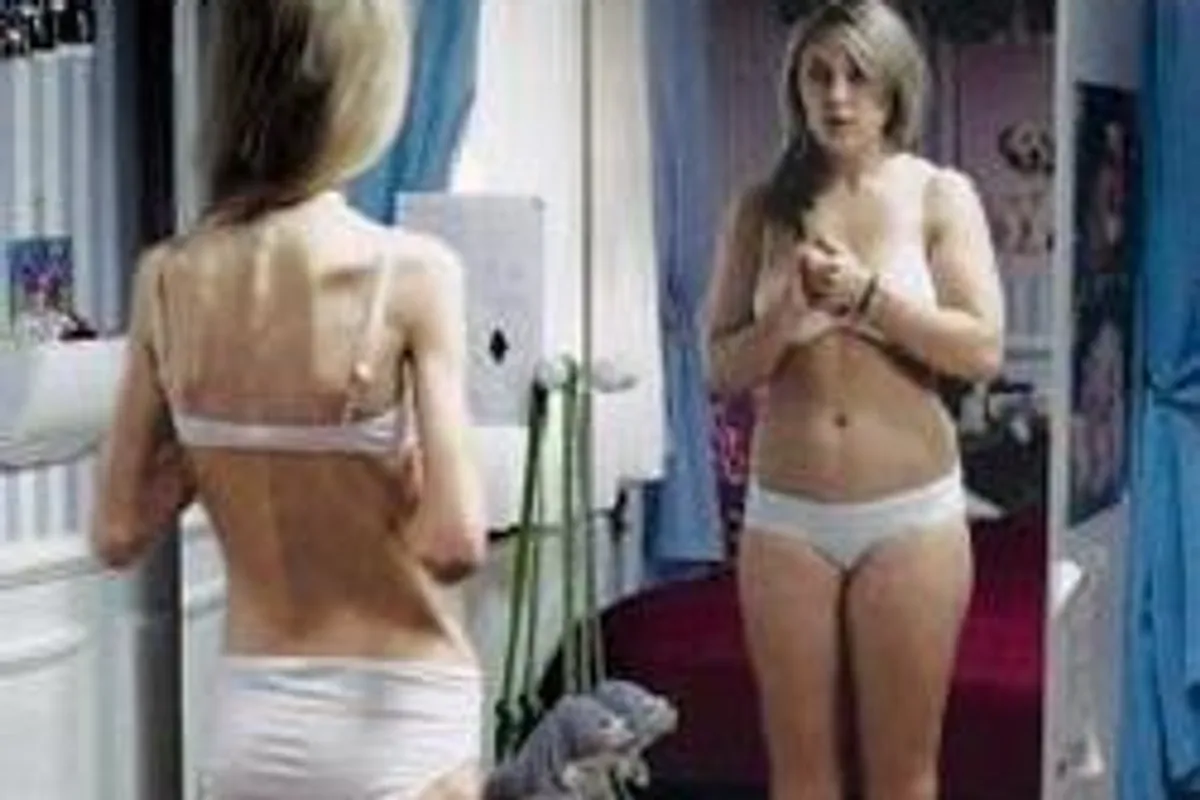 Anorexia nervosa – uzroci, simptomi i načini liječenja