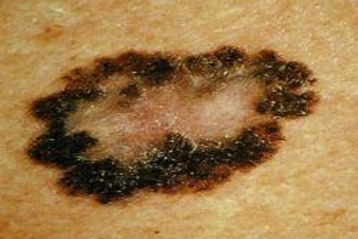EUROMELANOMA DAY: Gledajte svoje madeže redovito; otkrijte melanom što ranije!