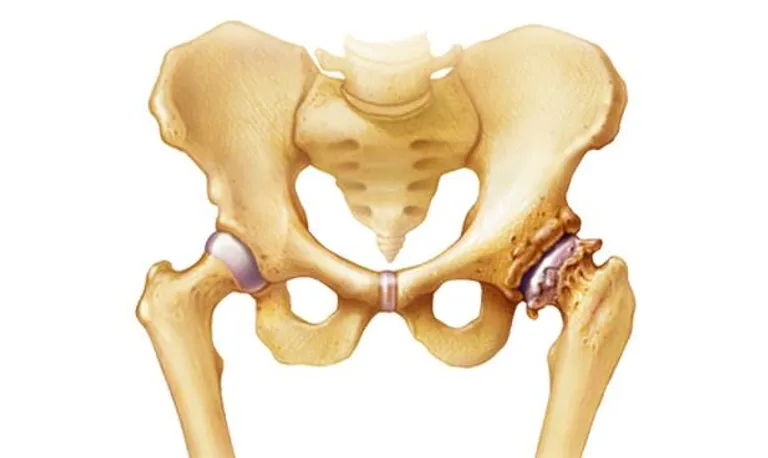uzrokuje akutna bol u zglobu kuka artroza liječenja alflutopom zgloba koljena