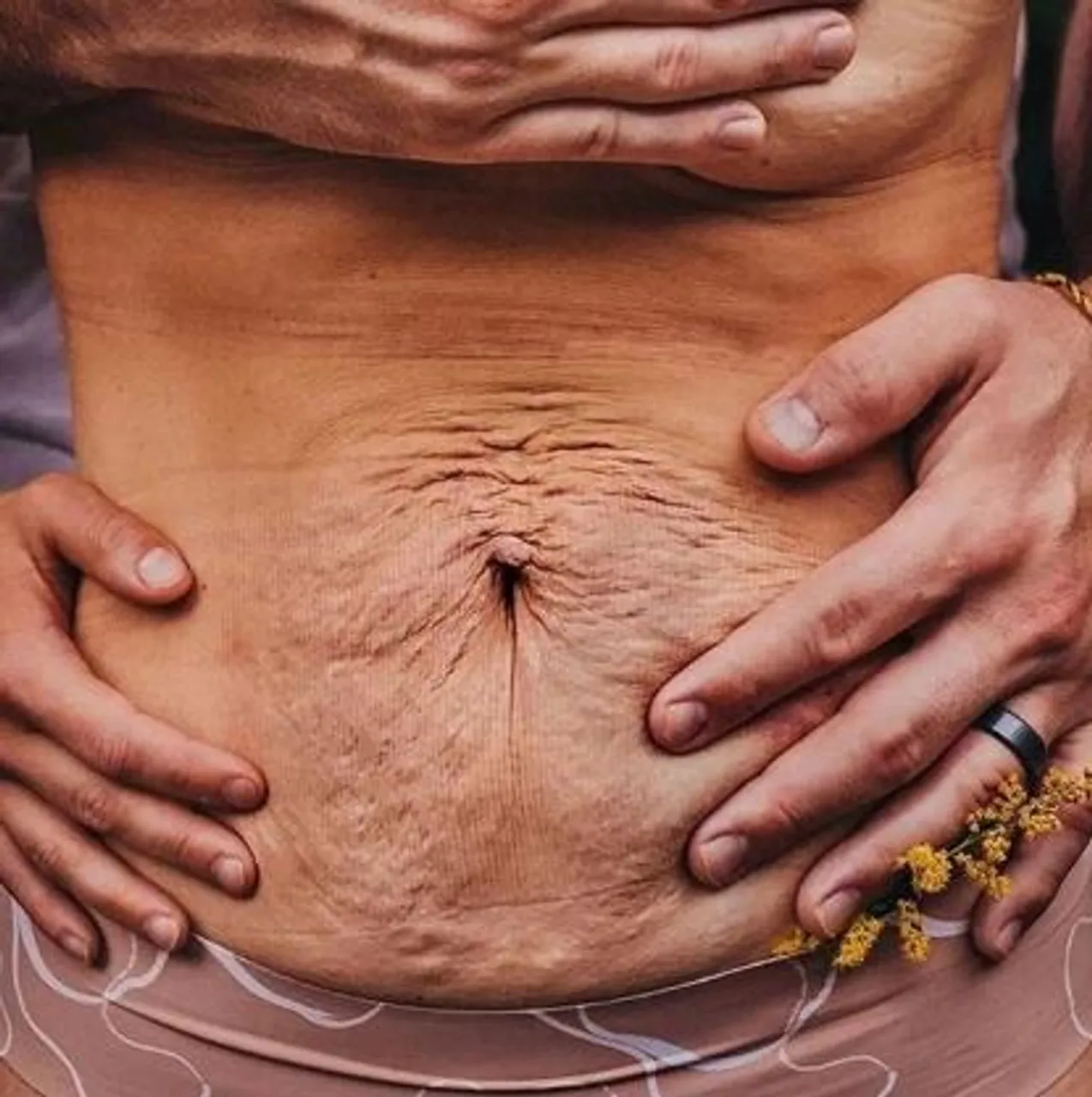 Za svaku pohvalu: 20 trudnica pokazalo svoj 'nesavršeni' trbuh nakon poroda