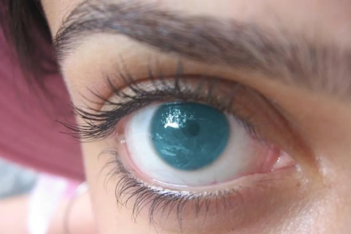 Saznajte što je keratokonus – njegujte vid i zdravlje vaših očiju!