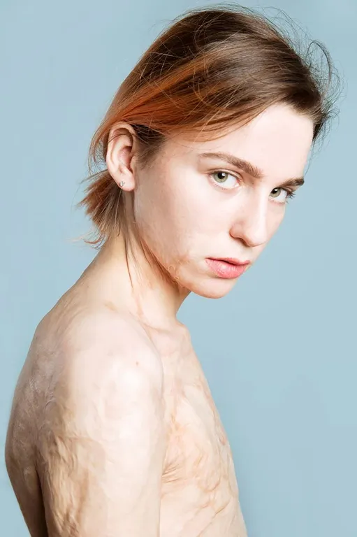Remarkable Russian model who suffered appalling burns aged four leaving her permanently without breasts tells of harrowing past when