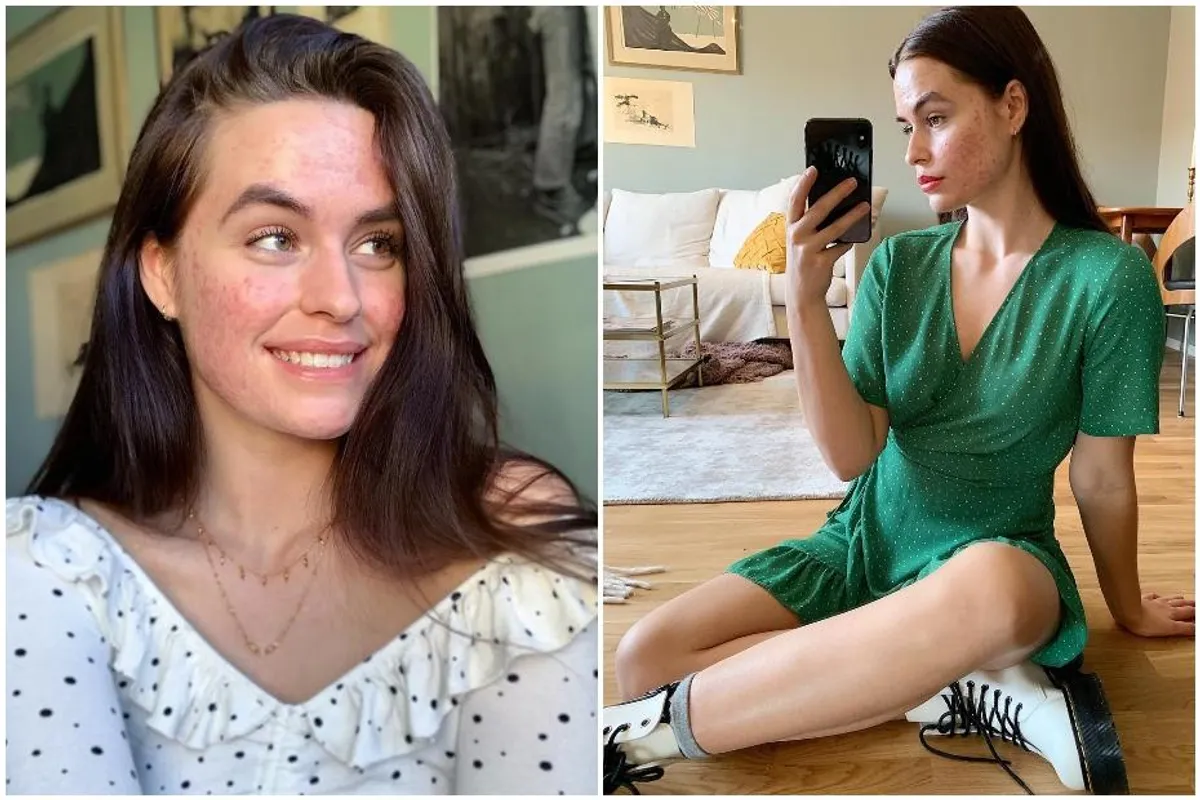 Mlada Šveđanka na svom Instagram profilu podiže svijest o borbi s aknama i ne boji ih se pokazati