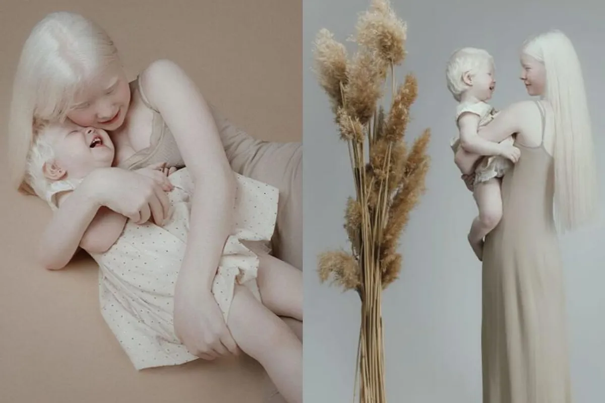 Albino sestre osvojile društvene mreže svojim fotografijama